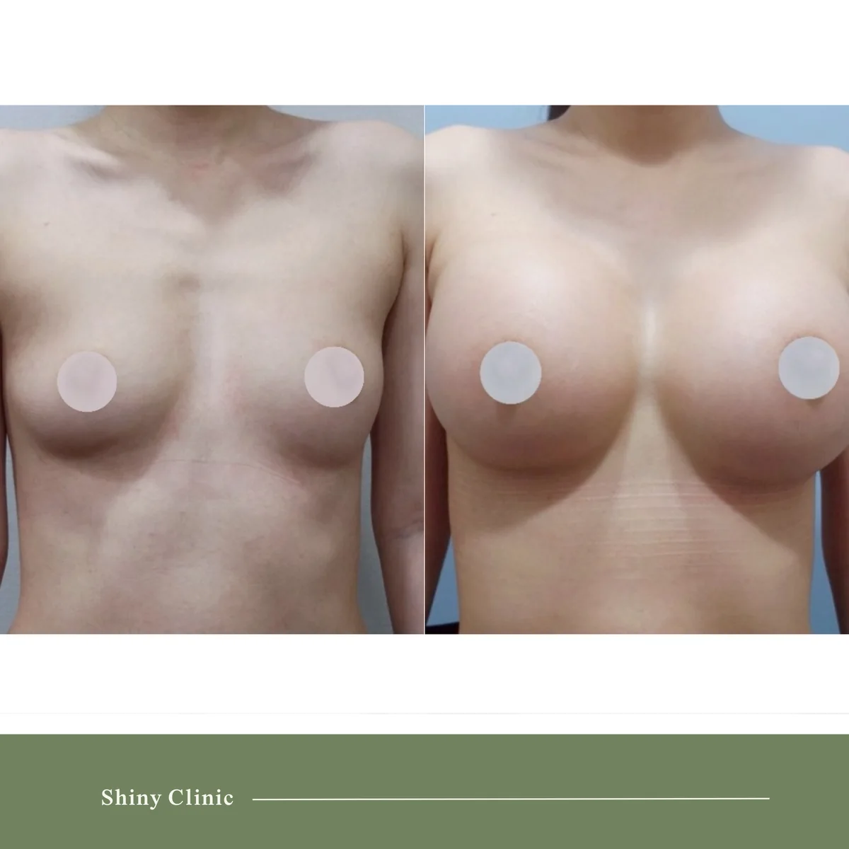 隆乳手術案例 4