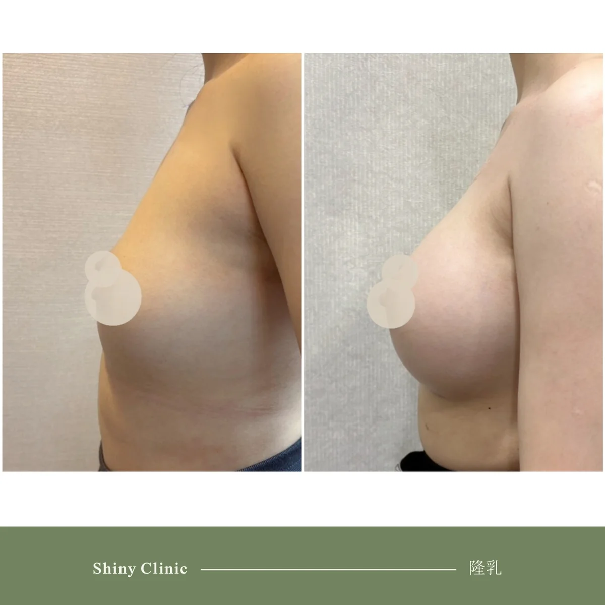 隆乳手術案例 9