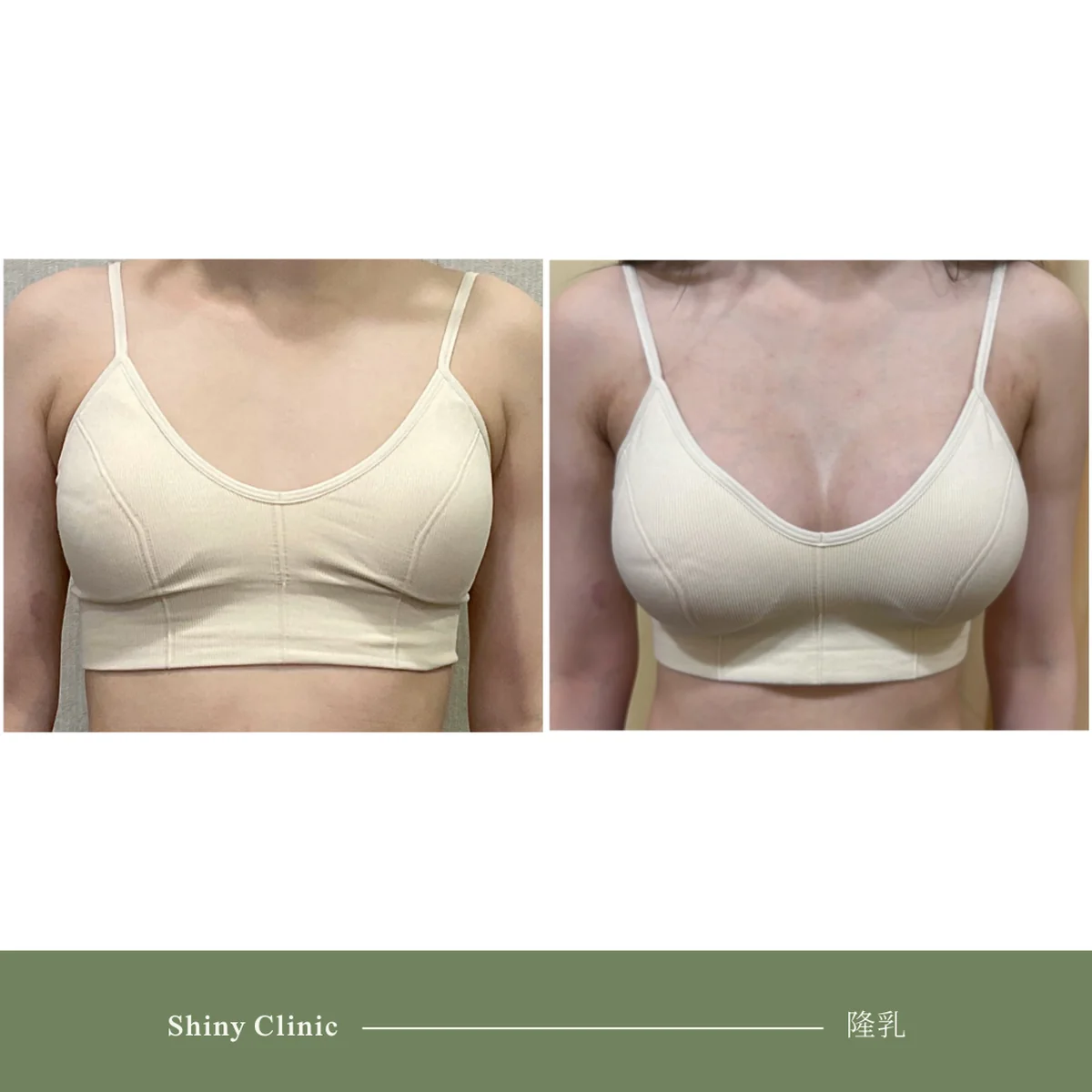 隆乳手術案例 15