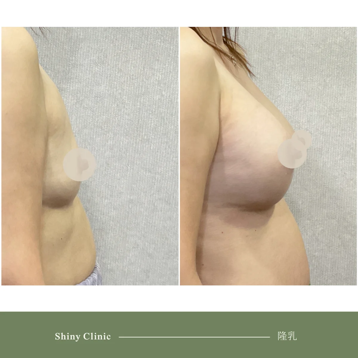 隆乳手術案例 34