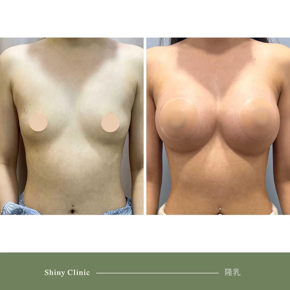 隆乳手術案例 35