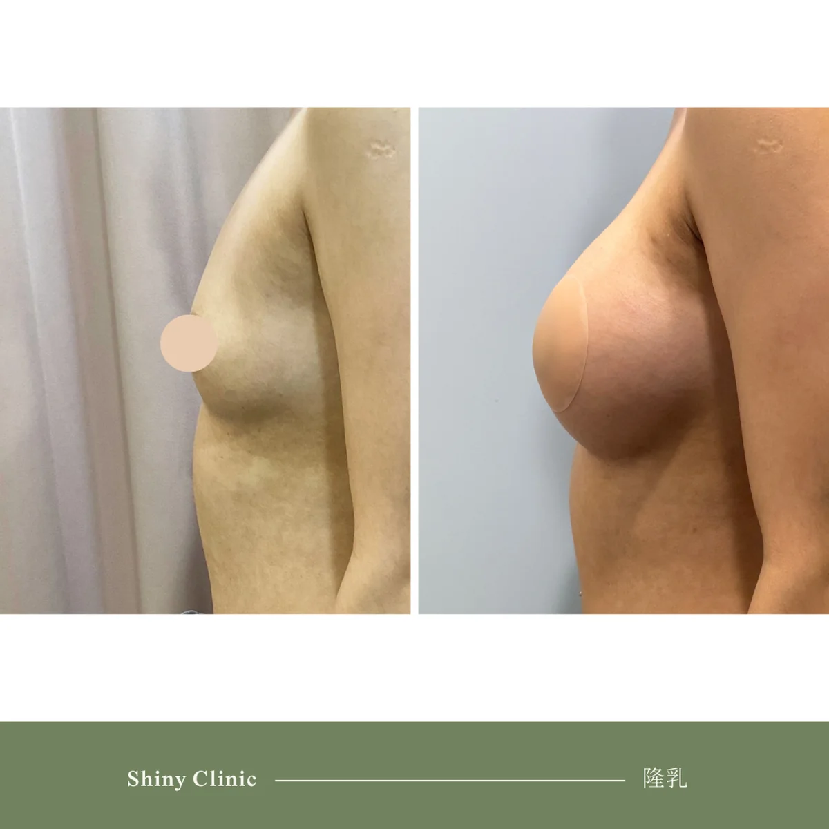 隆乳手術案例 39