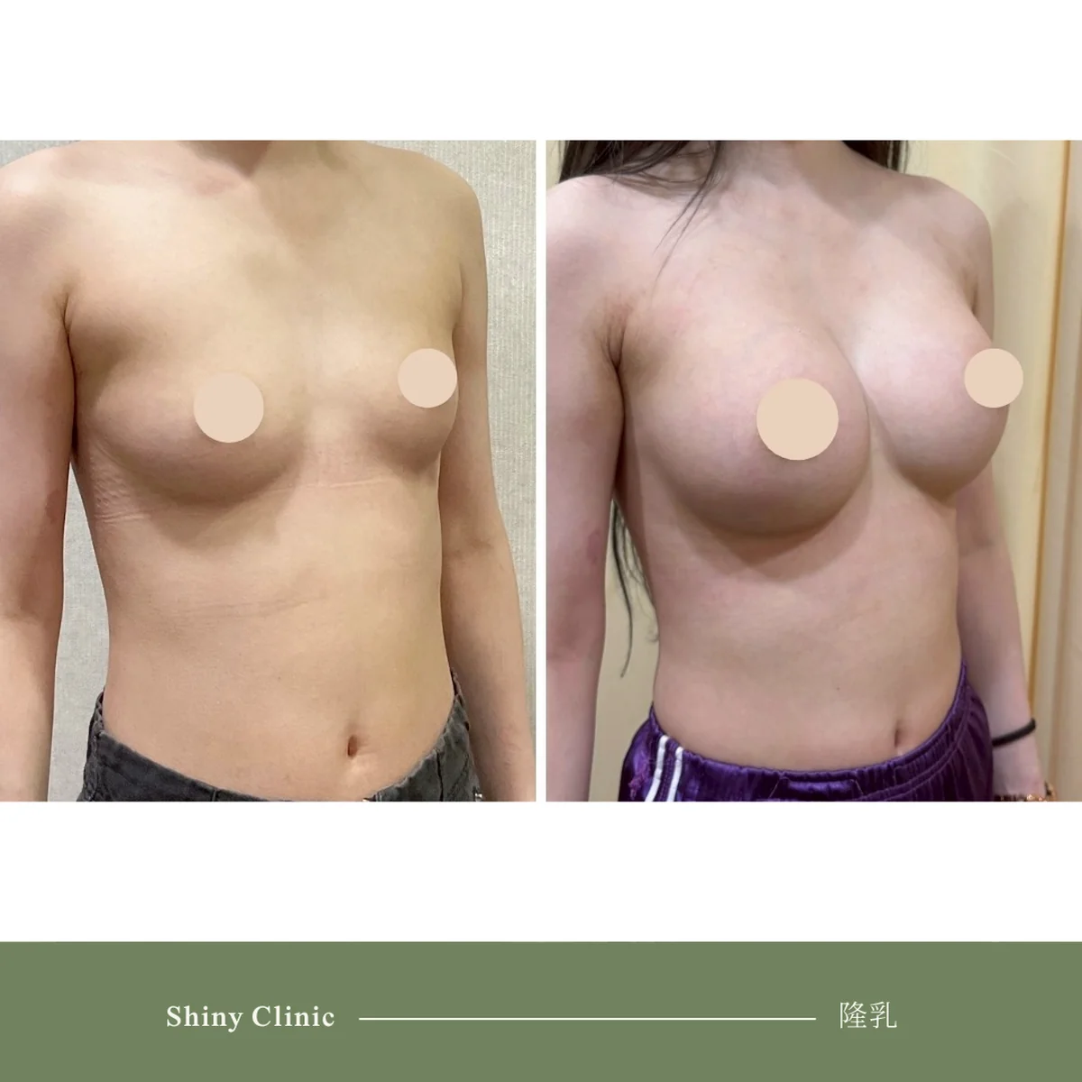 隆乳手術案例 49