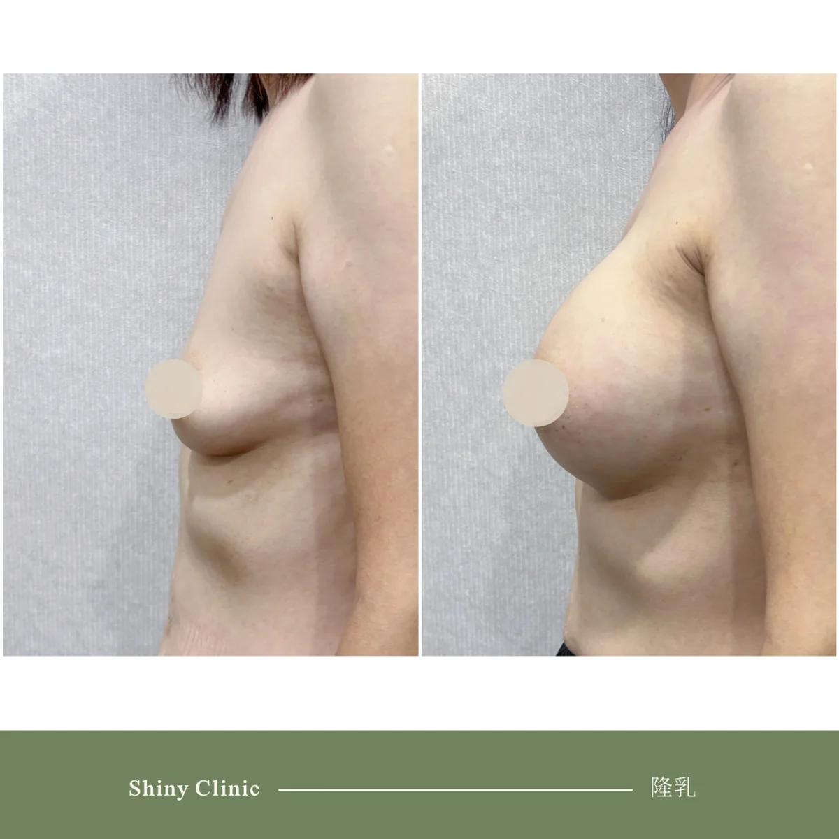 隆乳手術案例 52