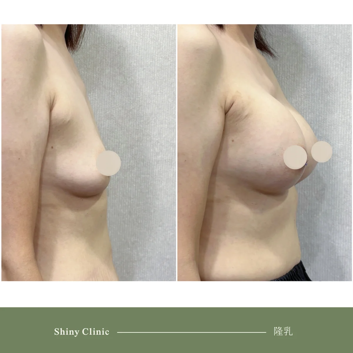 隆乳手術案例 53