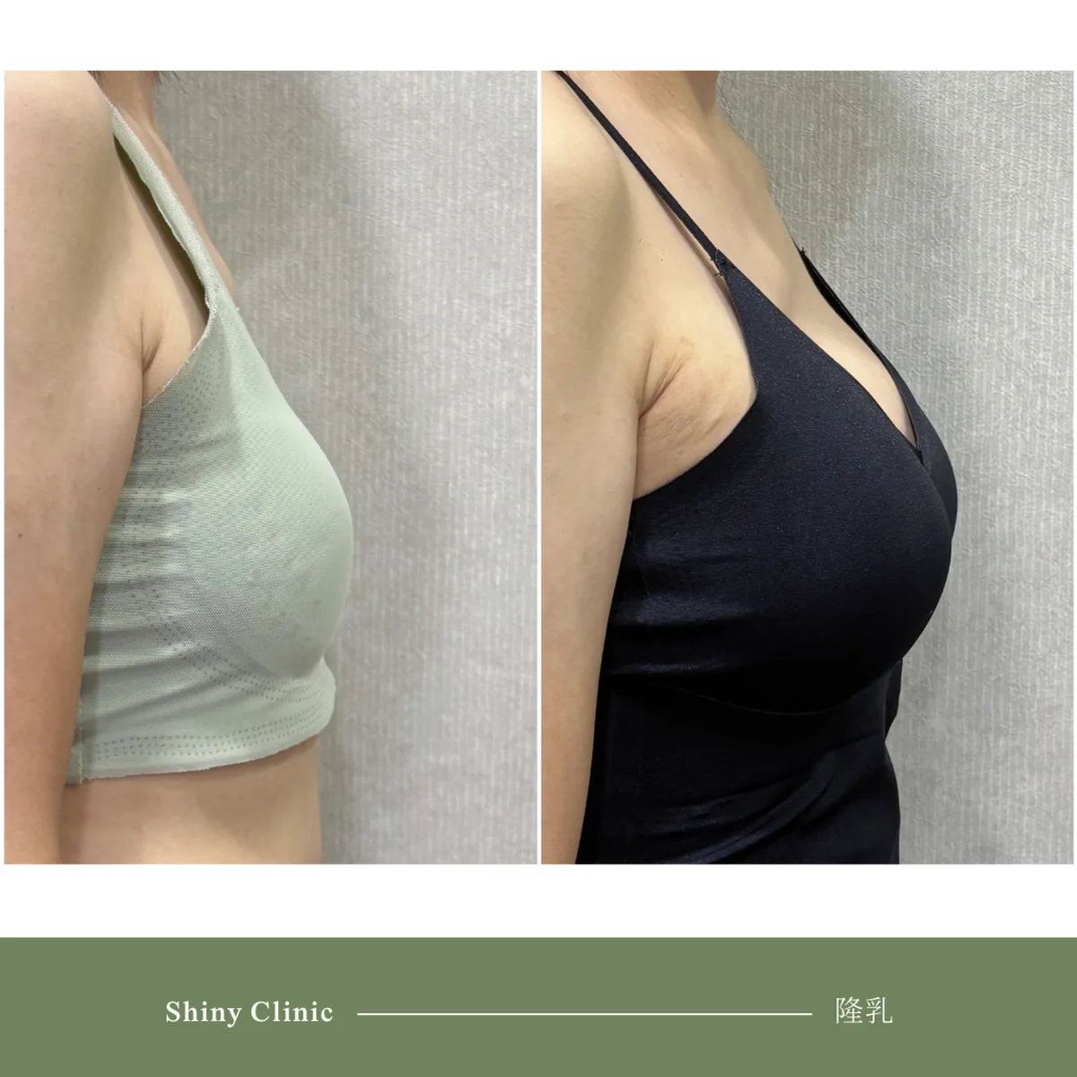 隆乳手術案例 55