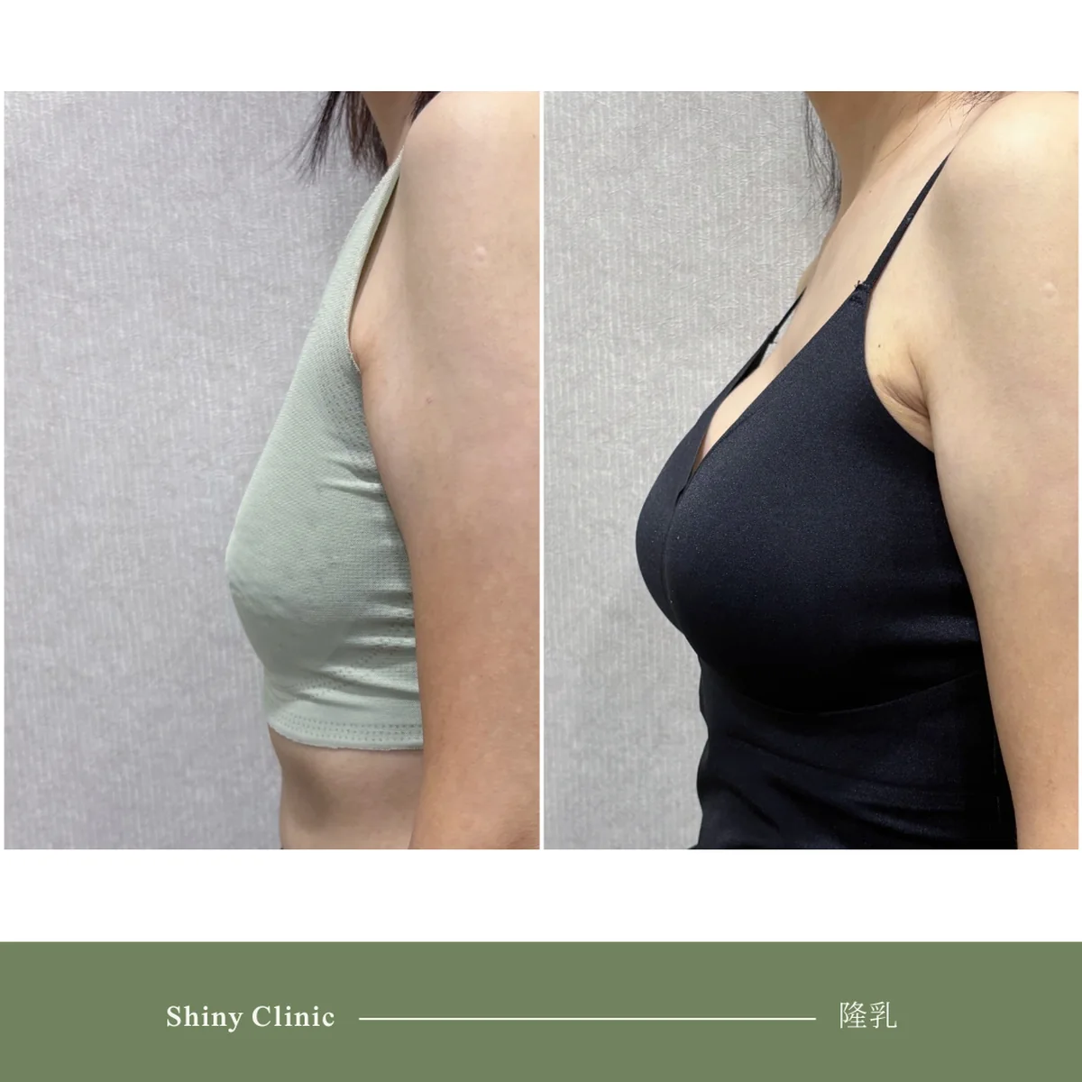 隆乳手術案例 56