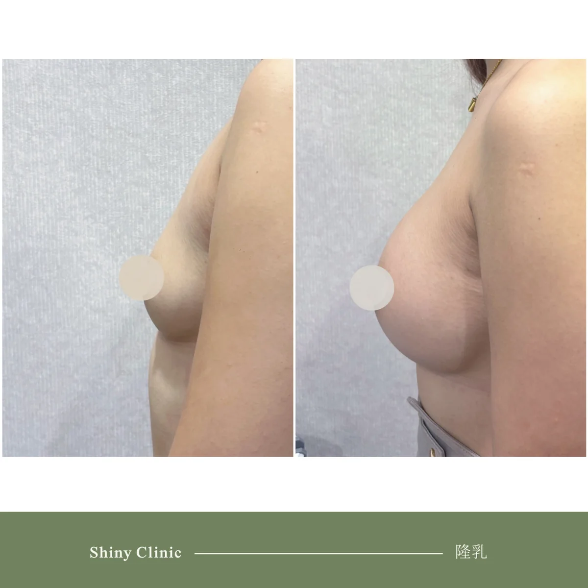 隆乳手術案例 75