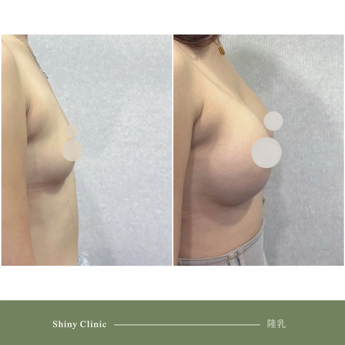 隆乳手術案例 76