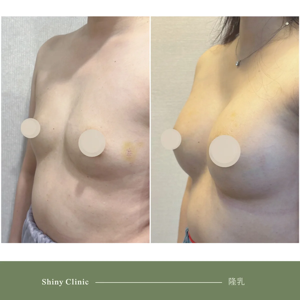 隆乳手術案例 80