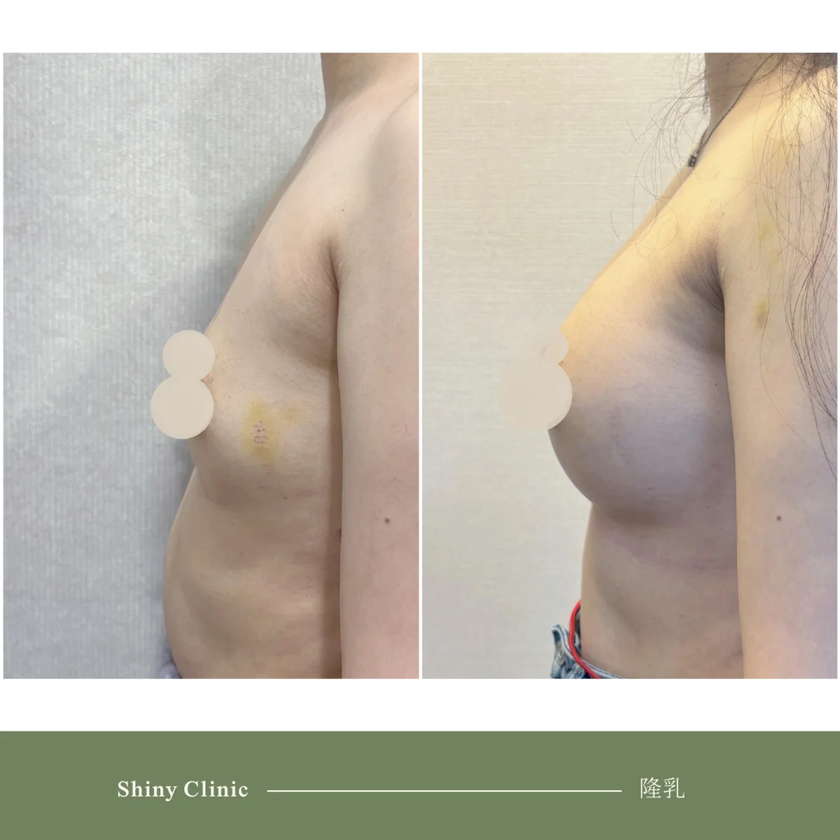 隆乳手術案例 81