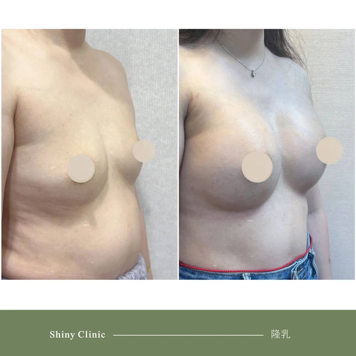 隆乳手術案例 83