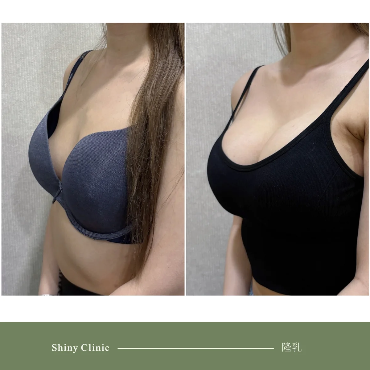 隆乳手術案例 84