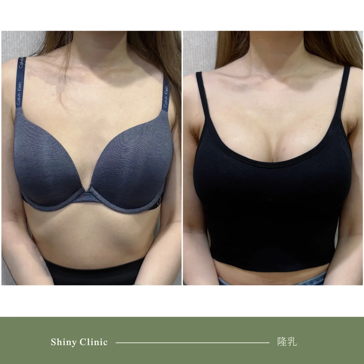 隆乳手術案例 85