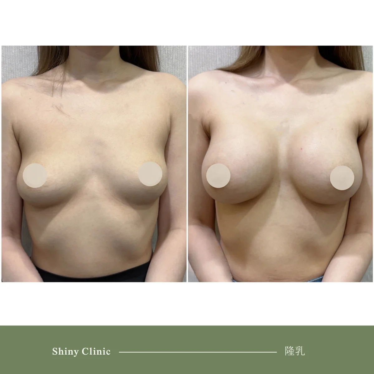 隆乳手術案例 86