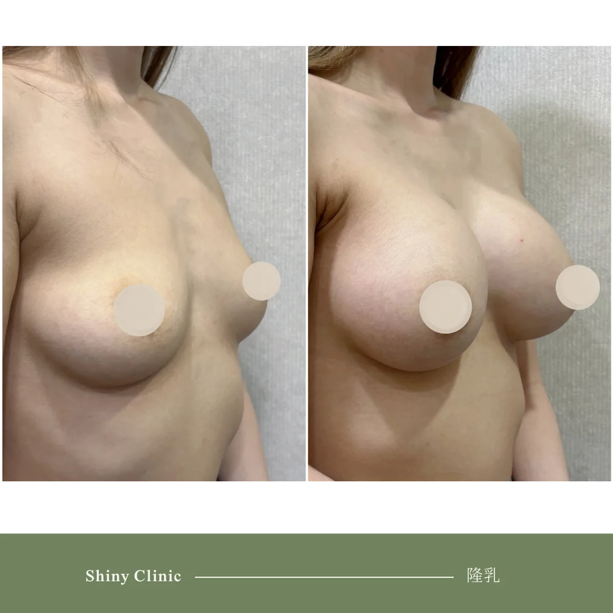 隆乳手術案例 89