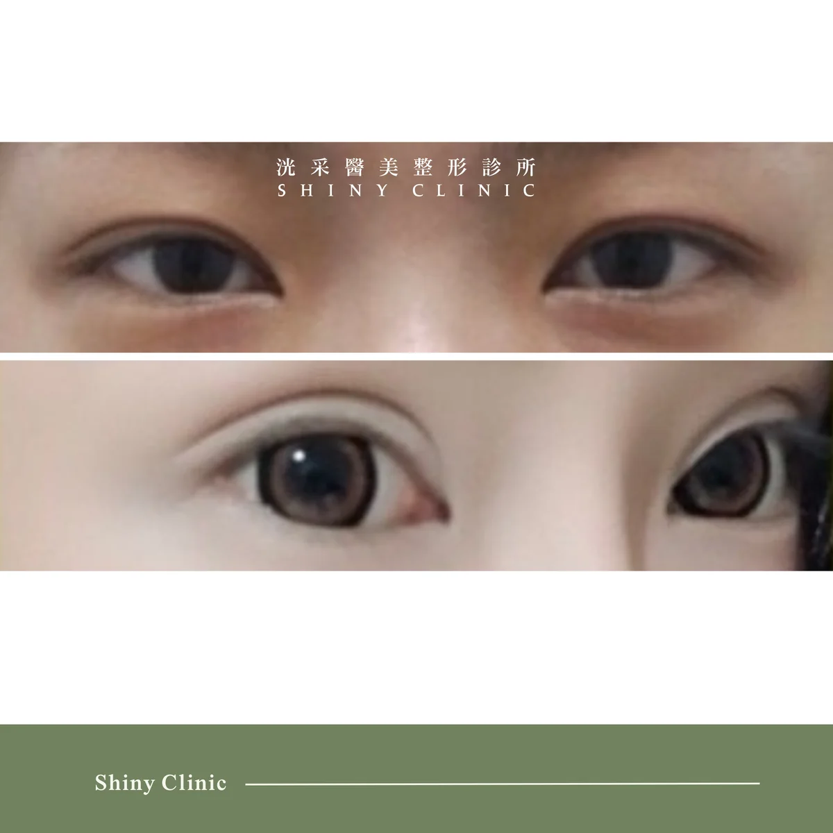 雙眼皮/提眼肌案例 2