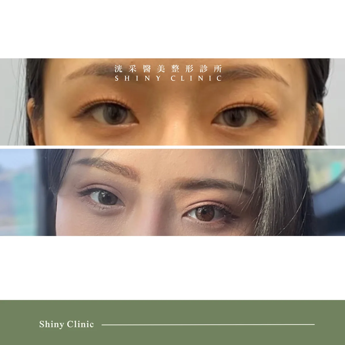 雙眼皮/提眼肌案例 3