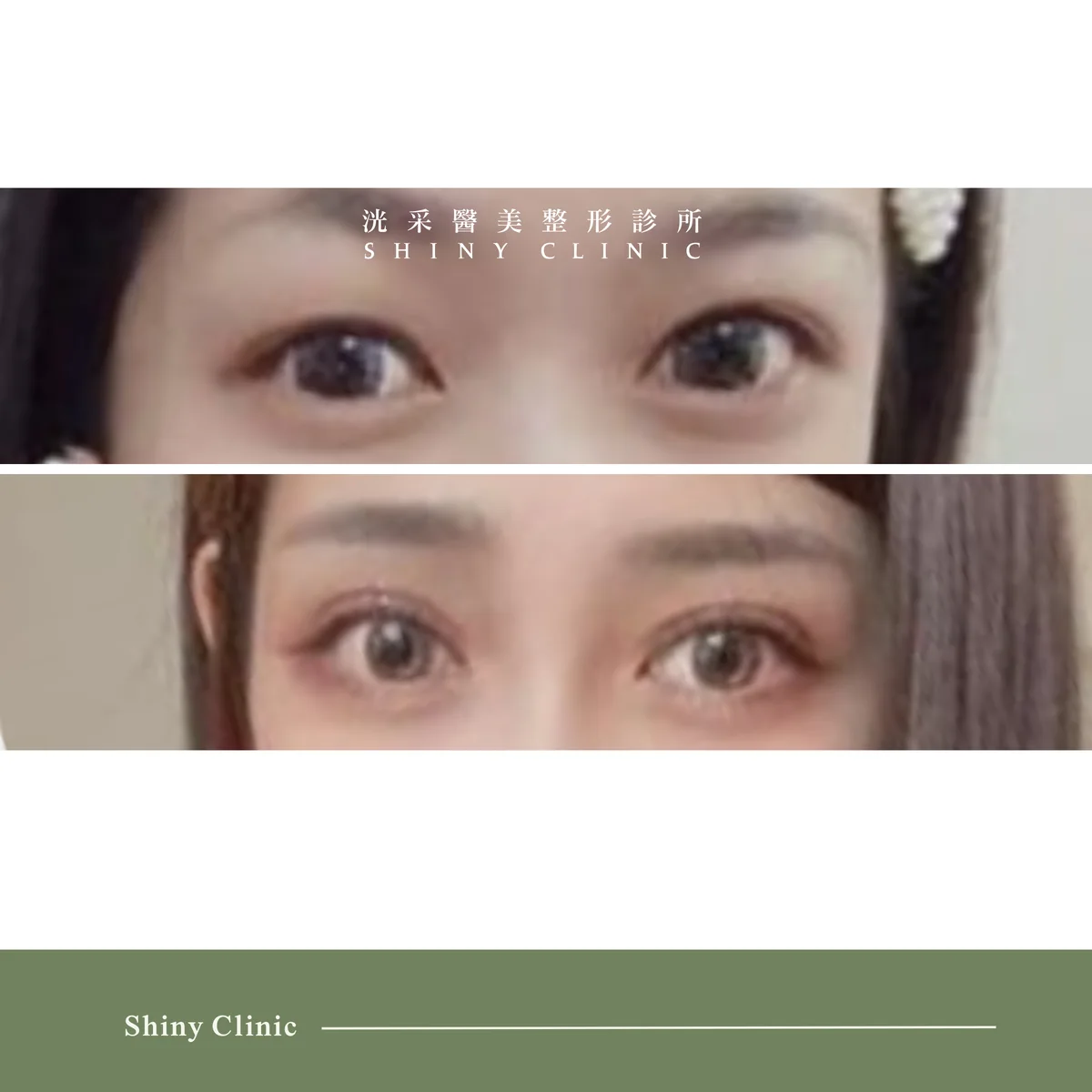 雙眼皮/提眼肌案例 4
