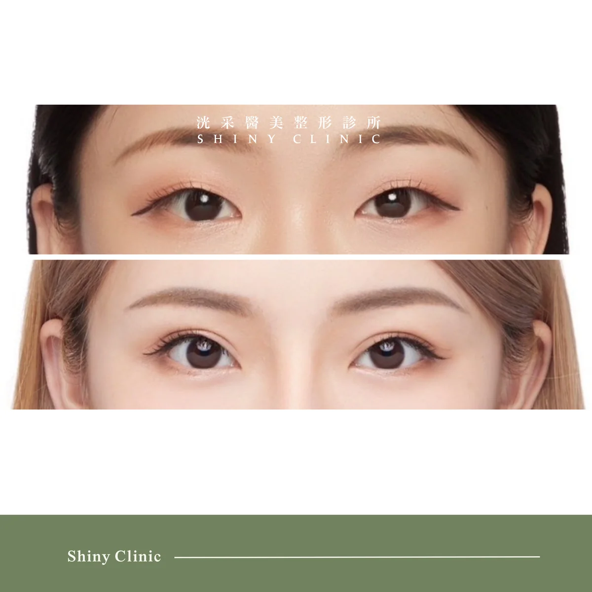 雙眼皮/提眼肌案例 7