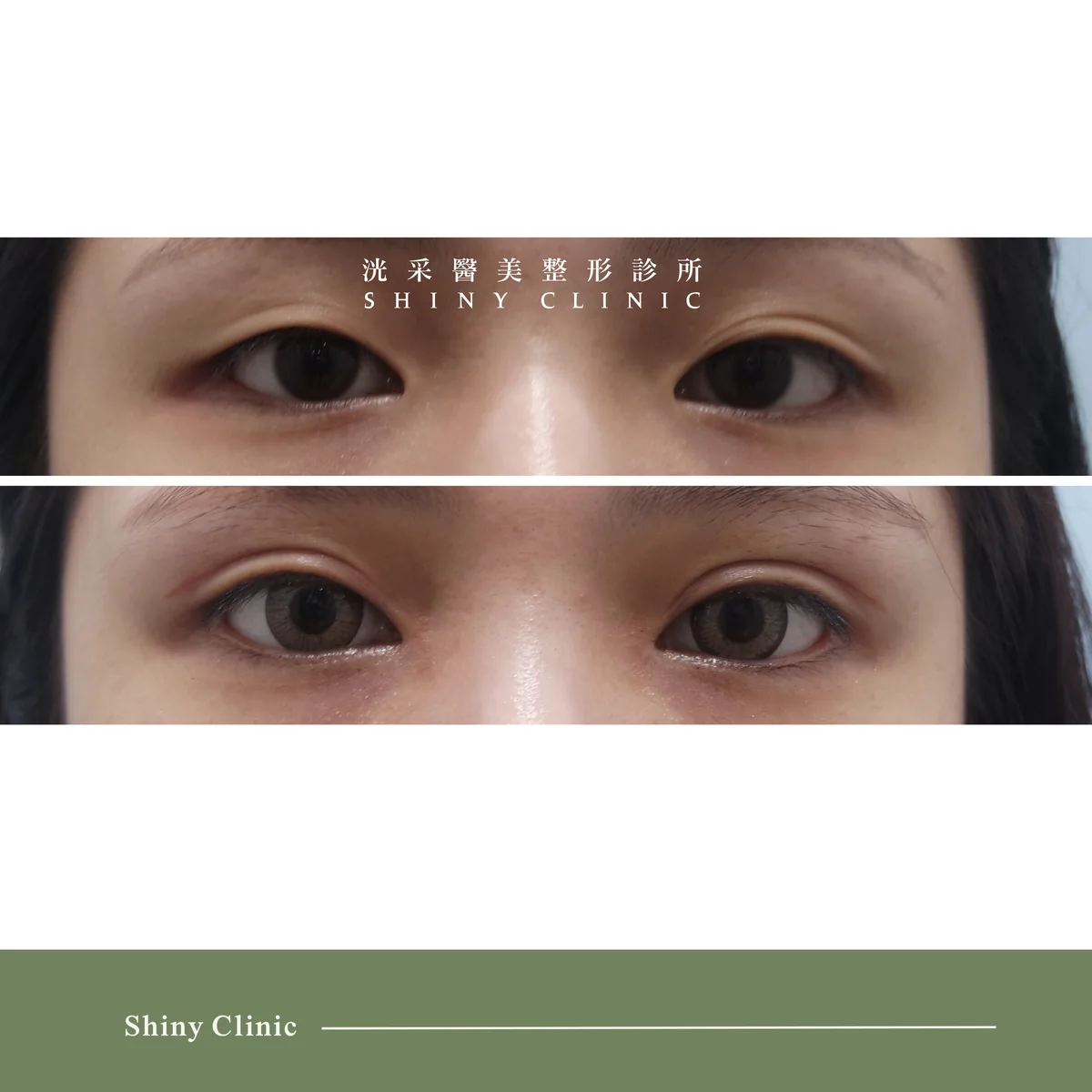 雙眼皮/提眼肌案例 8