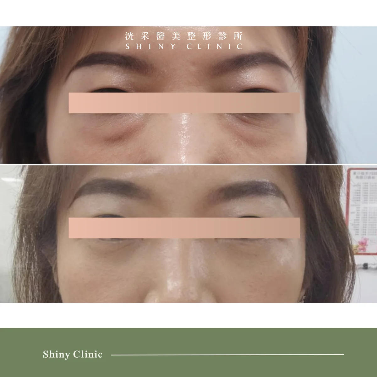 眼袋案例 1