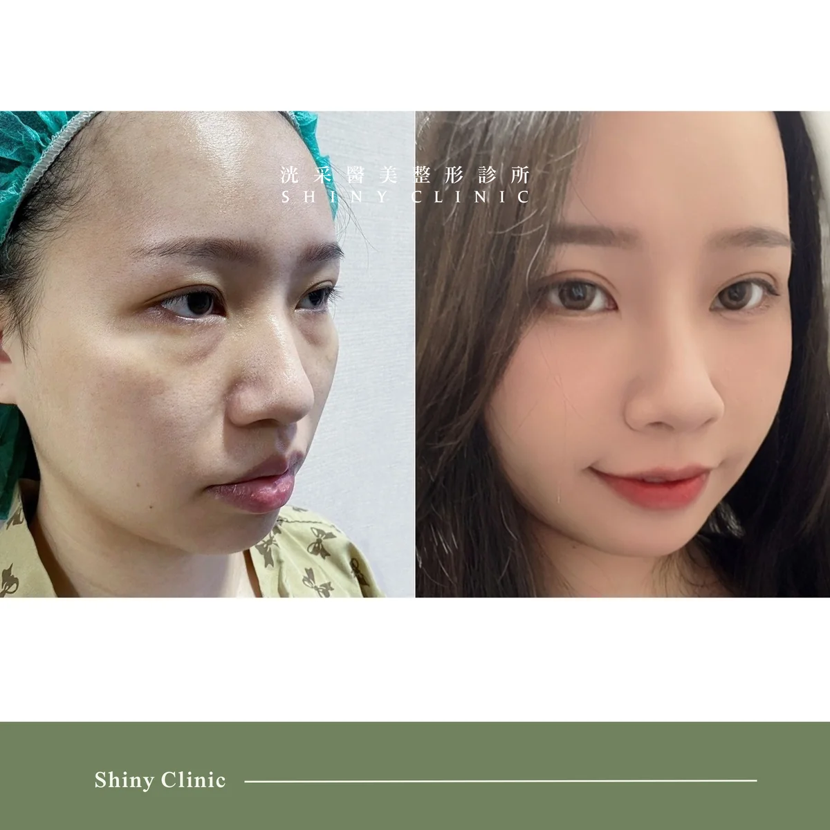 眼袋案例 4
