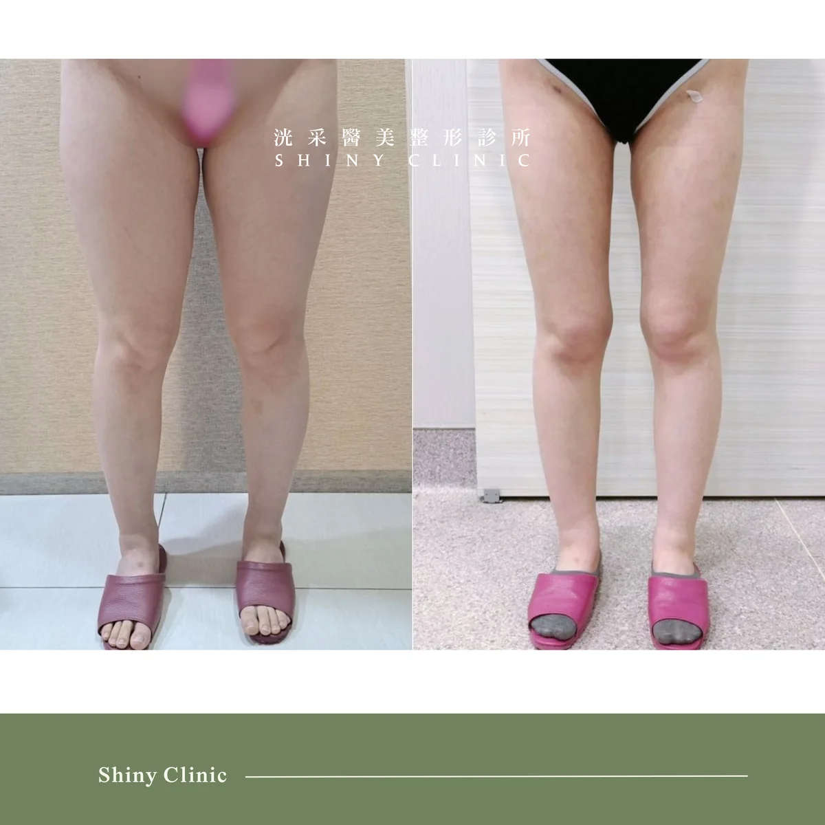 抽脂手術案例 3