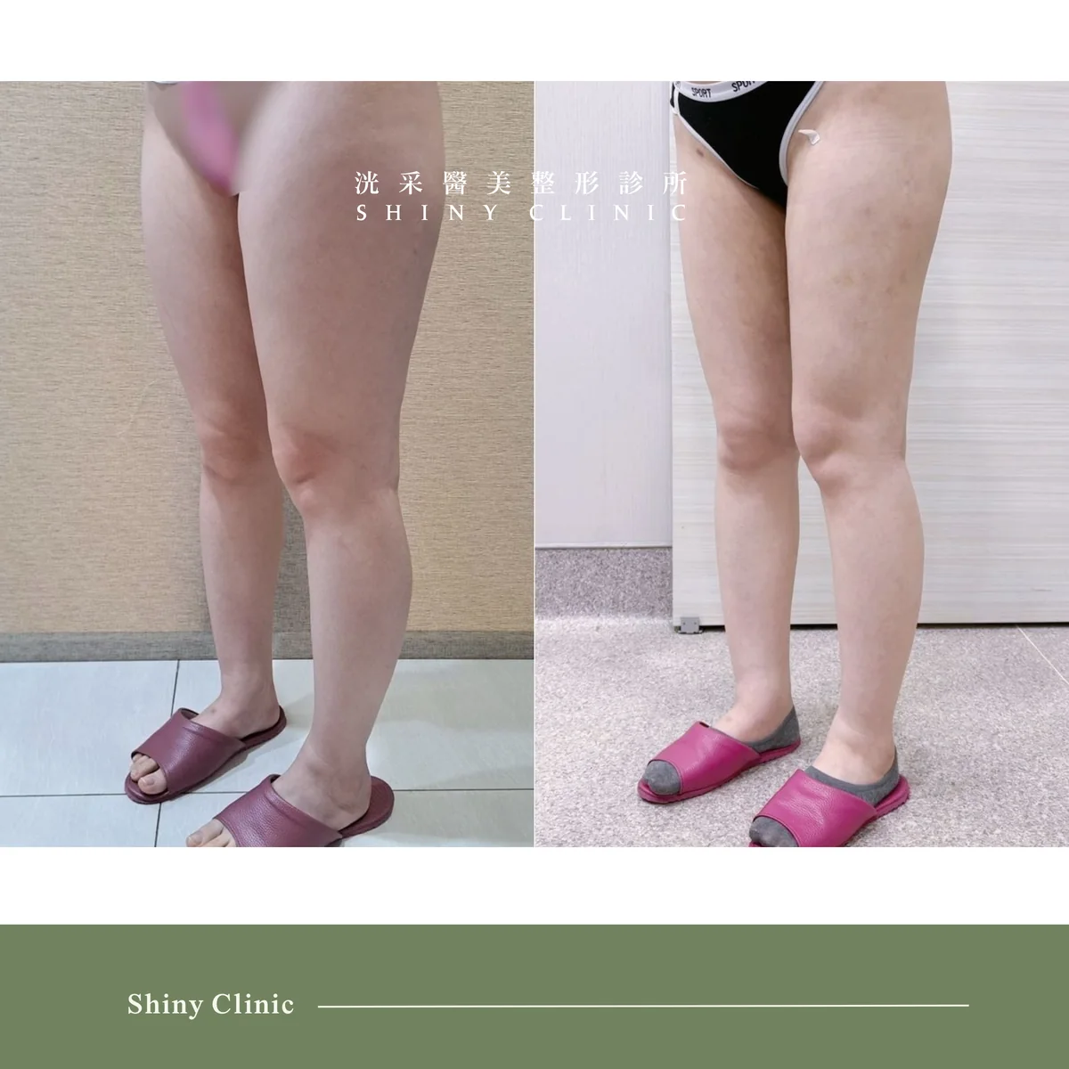抽脂手術案例 4