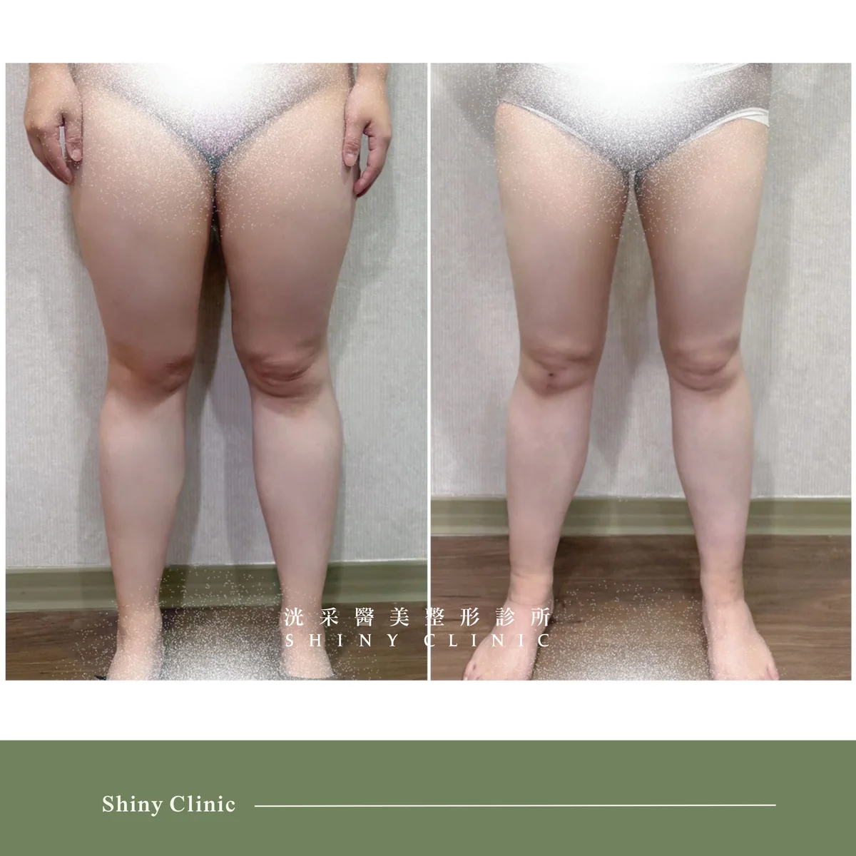 抽脂手術案例 20