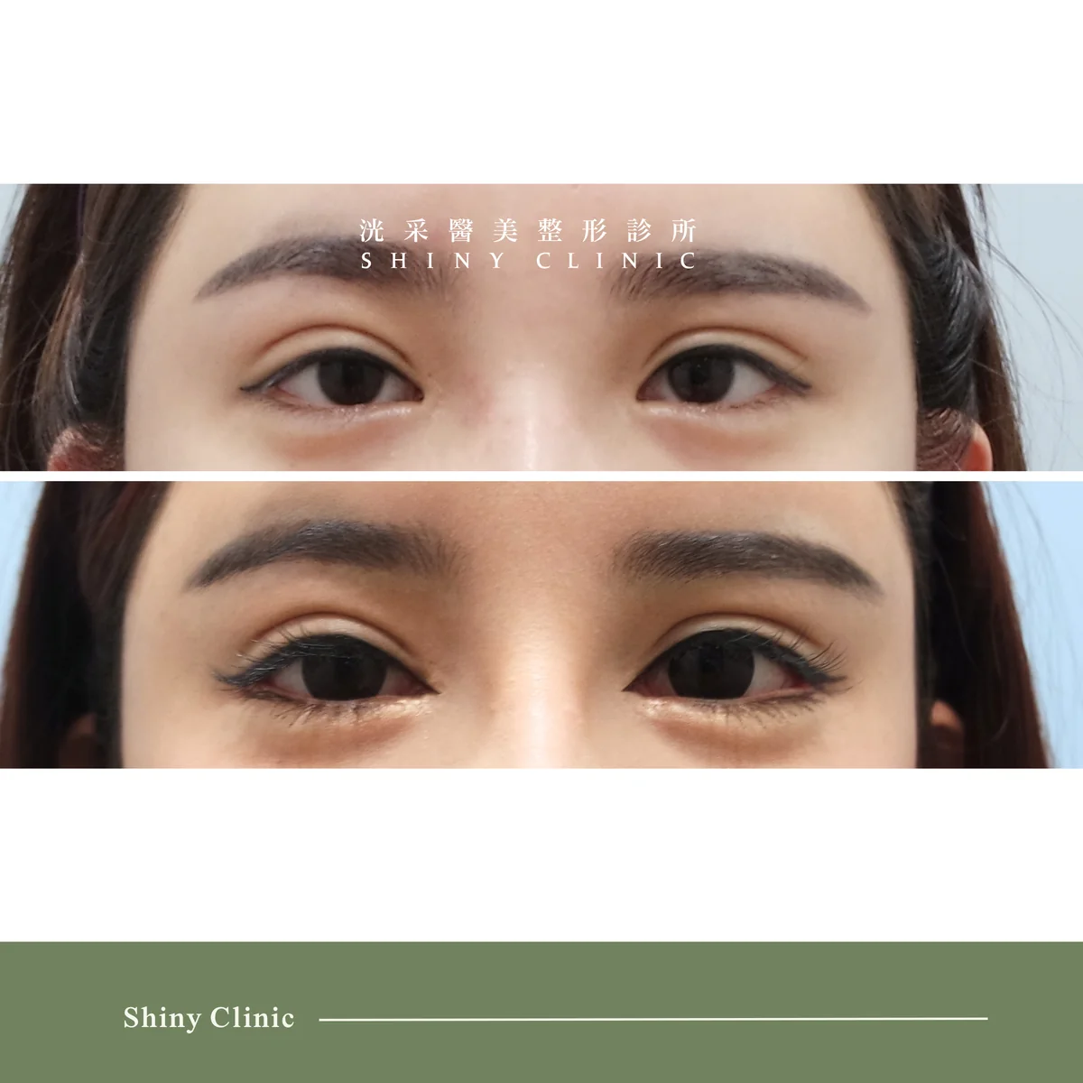 開眼頭/眼尾案例 1