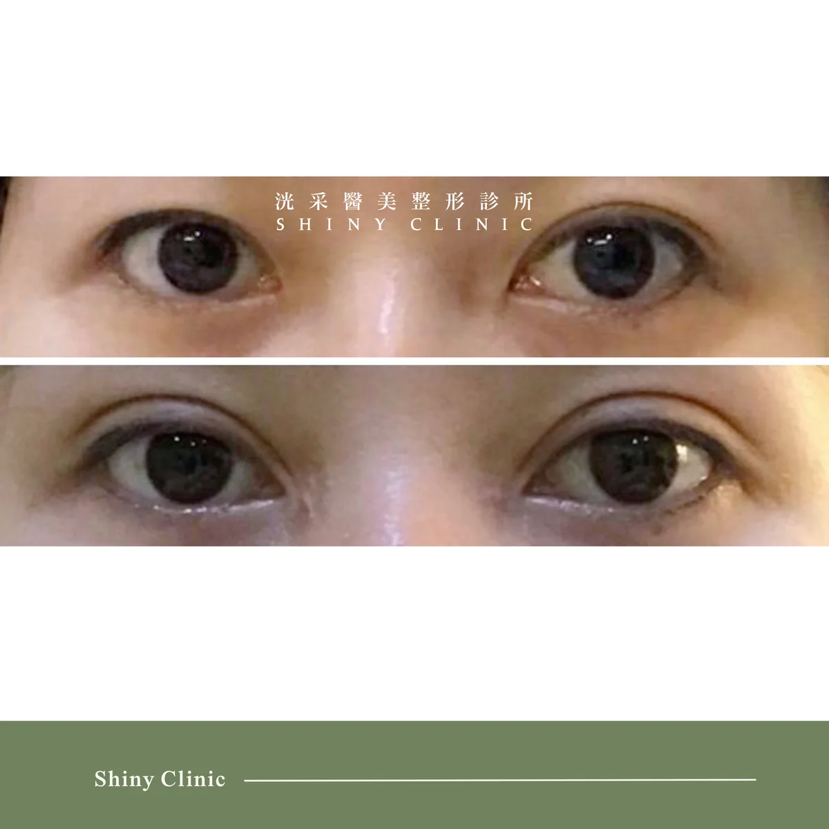 開眼頭/眼尾案例 2