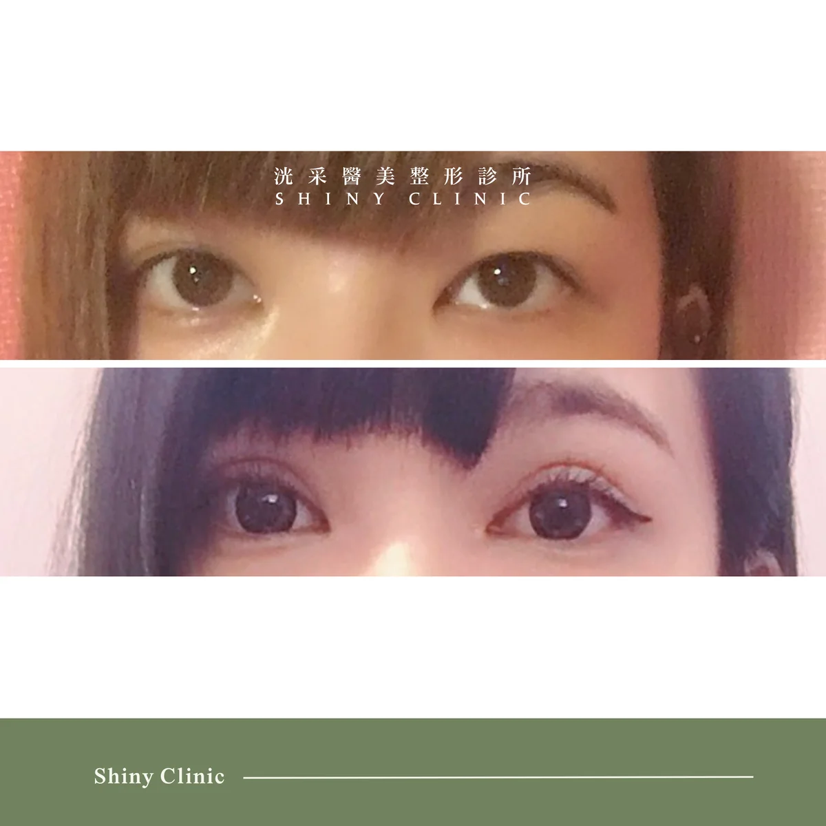 開眼頭/眼尾案例 3