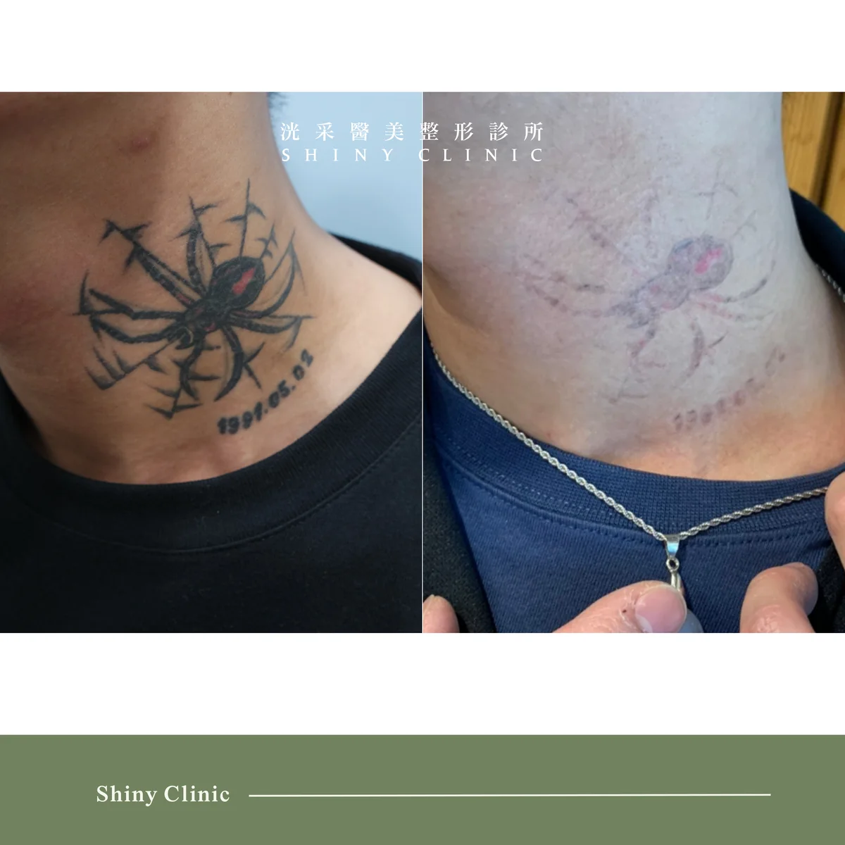 PicoQ皮秒雷射案例 2