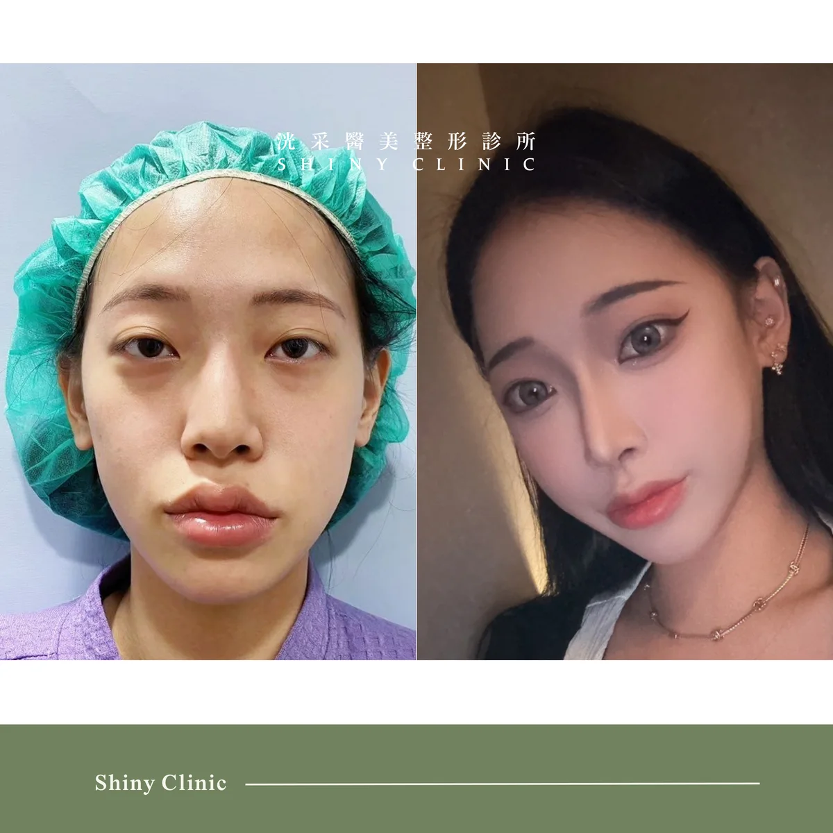 自體軟骨隆鼻案例 1