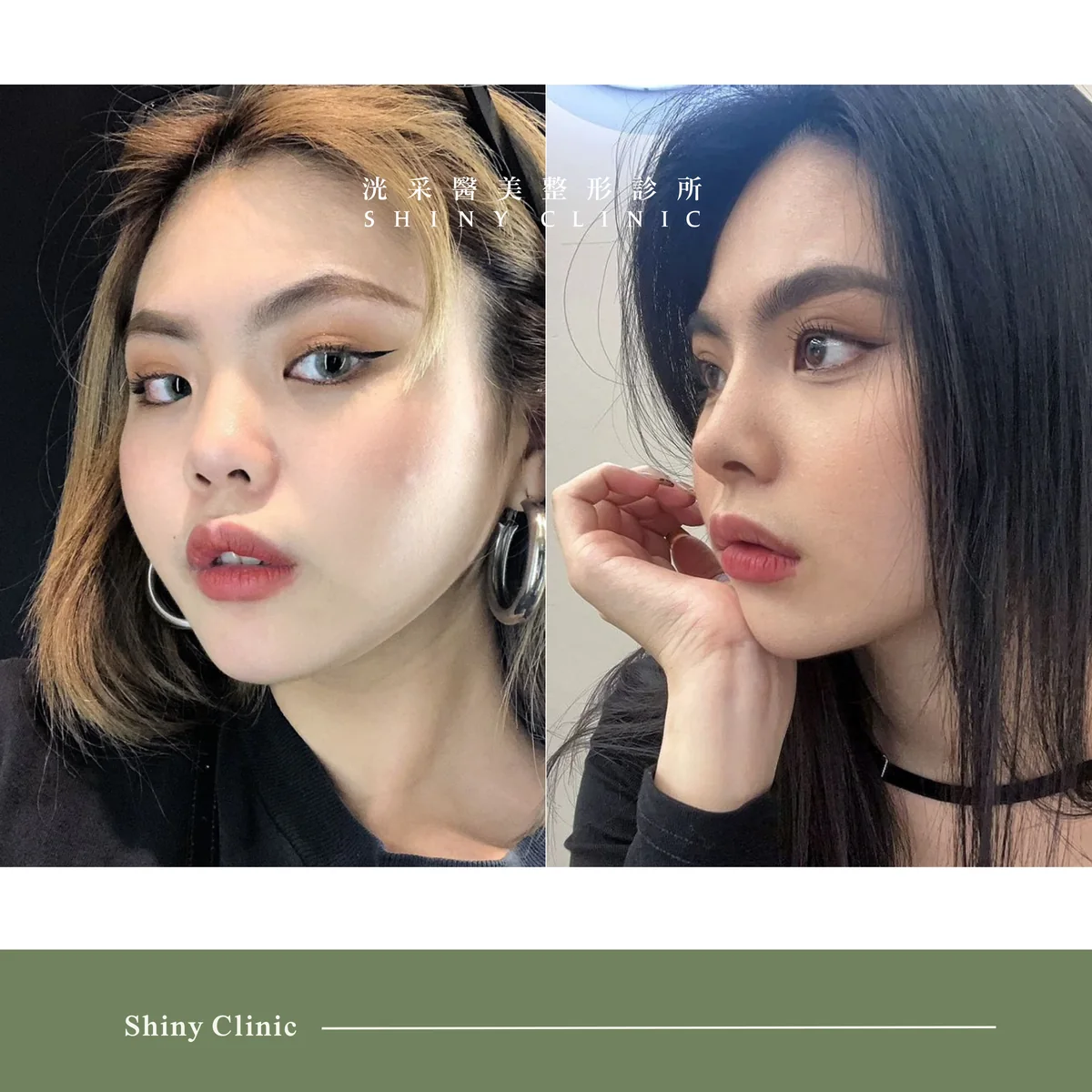 自體軟骨隆鼻案例 2