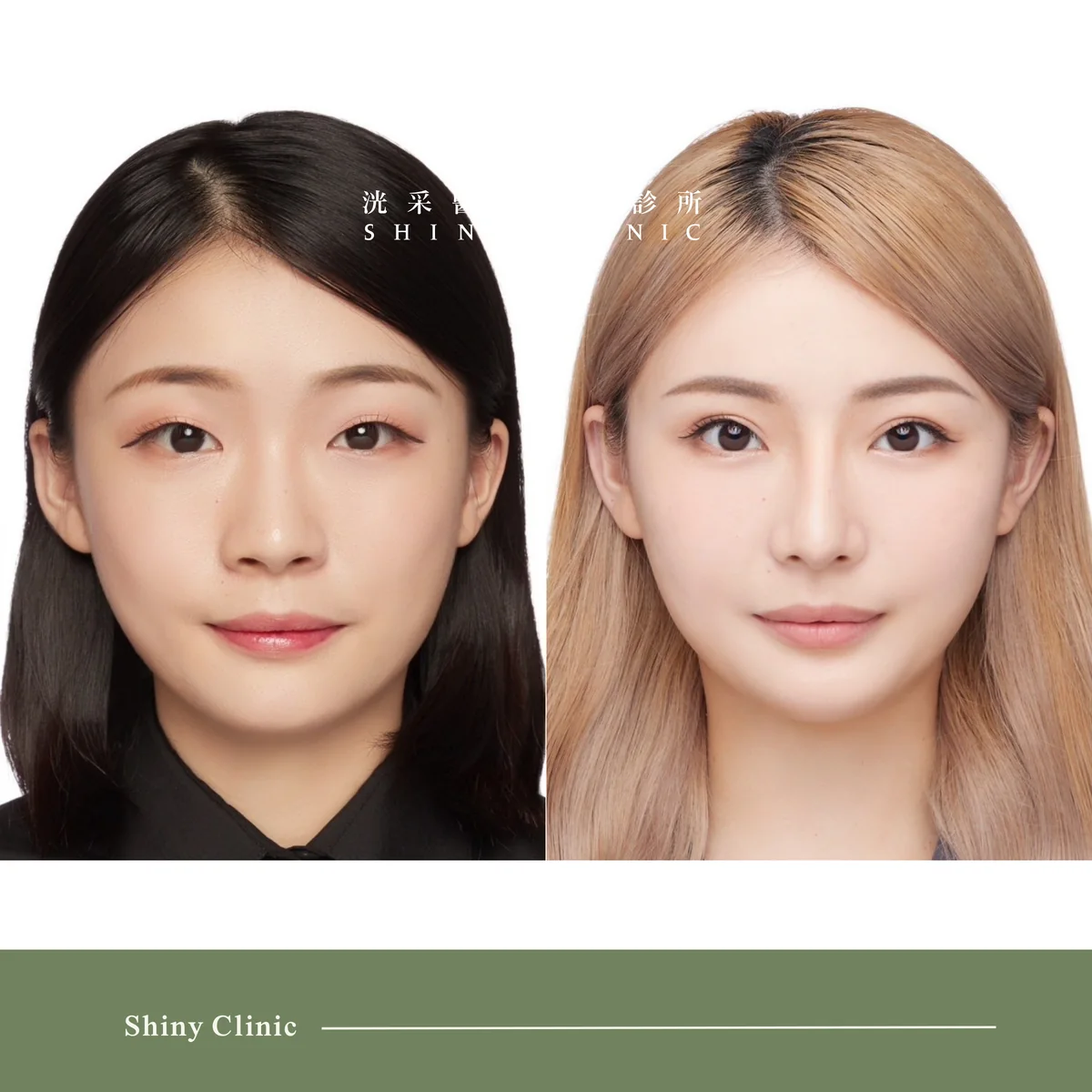 自體軟骨隆鼻案例 7