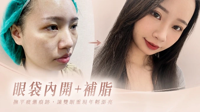 眼袋手術