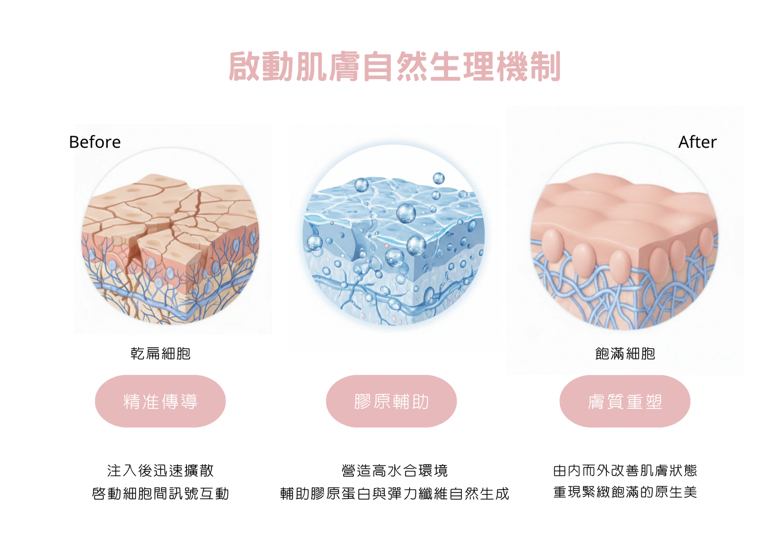 彈力針Doublyx EVO療程補充圖 5