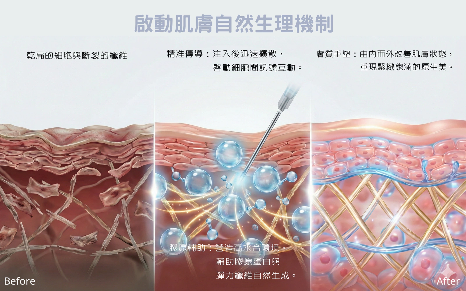 彈力針Doublyx EVO療程補充圖 6