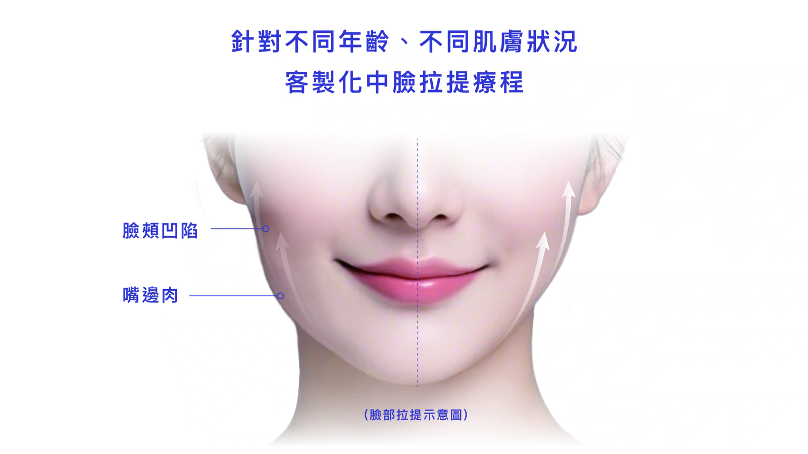Meteora Thread美特拉埋線拉提療程補充圖 7